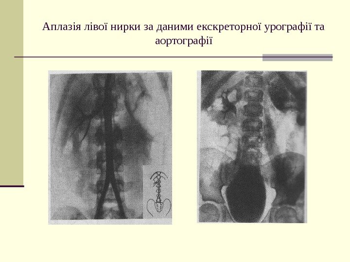   Аплазія лівої нирки за даними екскреторної урографії та аортографії 